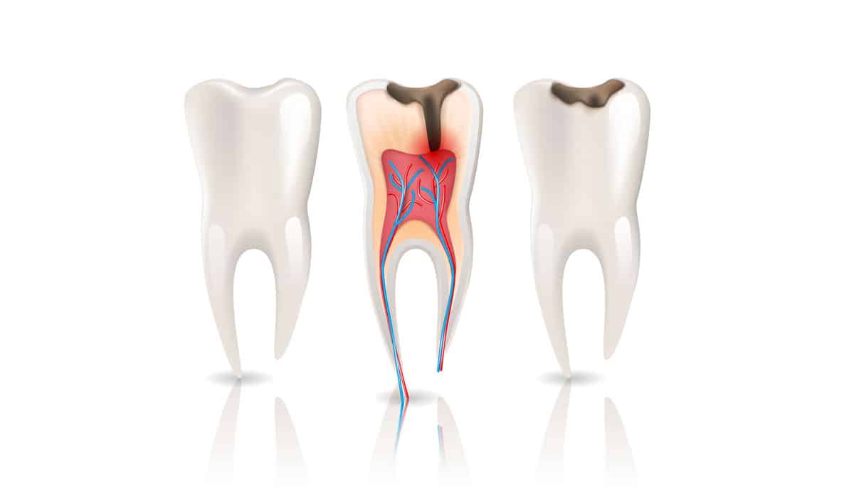 Pulpite dentale: cos’è, sintomi e cura