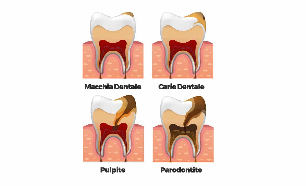 stadi pulite dentale