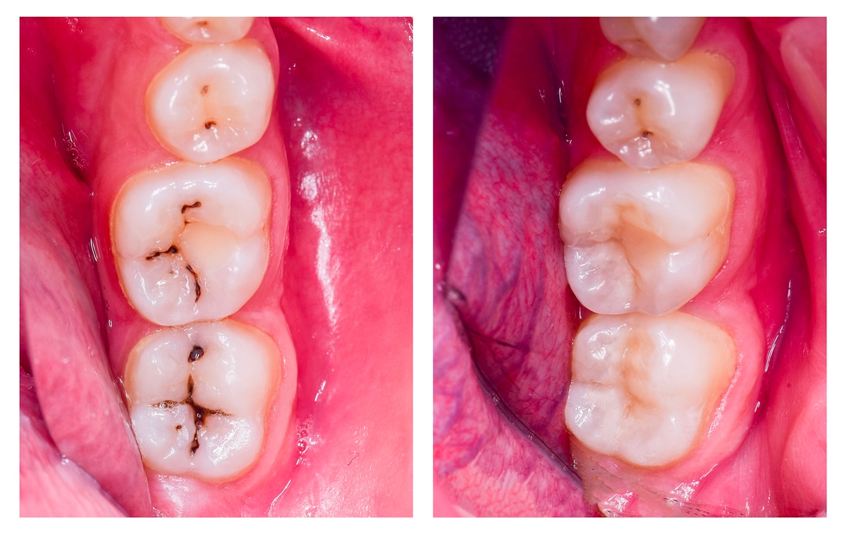 carie dentale prima e dopo