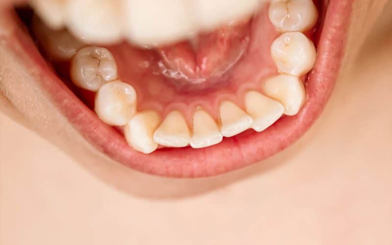 Tartaro sui denti: Tutto quello che devi sapere dalla A alla Z