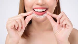 alternative invisalign