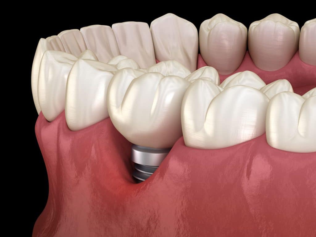 impianti dentali e parodontite