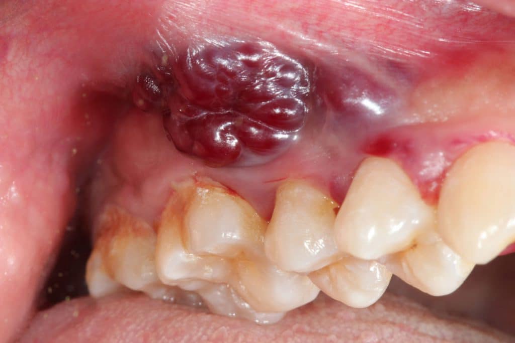 tumore della bocca