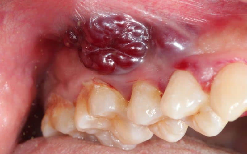 Tumore della bocca: cause, sintomi, diagnosi, cura e prevenzione