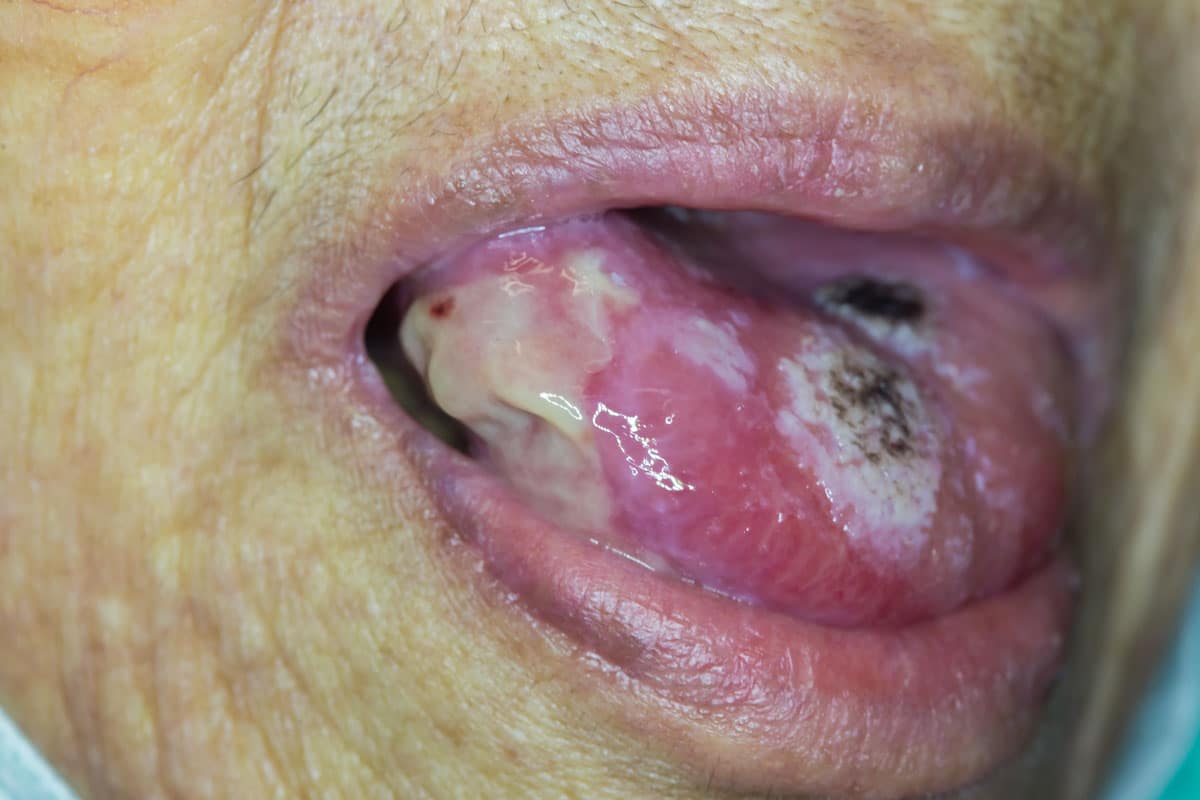 tumore alla lingua in stadio avanzato