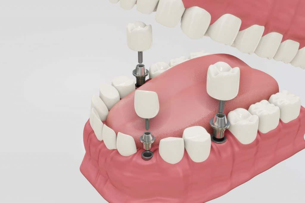 nuove tecniche di implantologia dentale