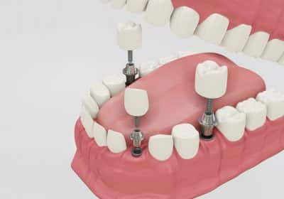 nuove tecniche di implantologia dentale