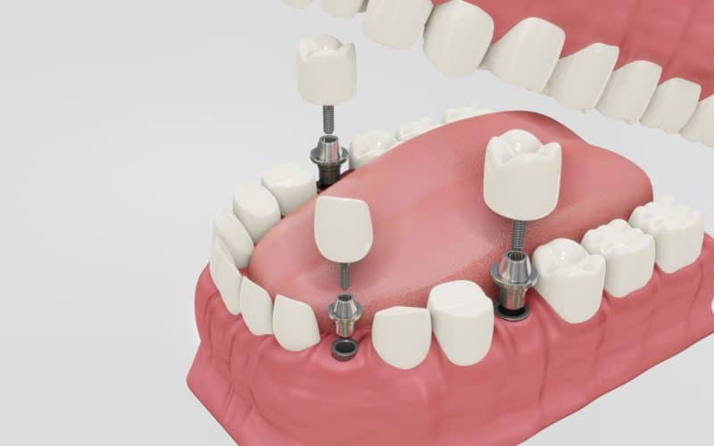 Nuove tecniche di implantologia dentale nel 2023