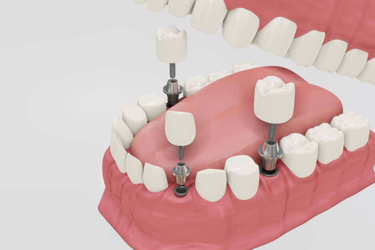 Nuove tecniche di implantologia dentale nel 2026