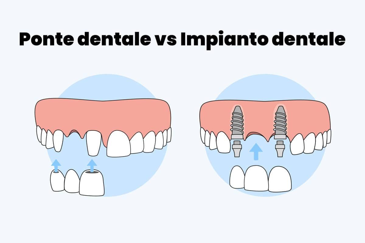 ponte dentale vs impianto dentale