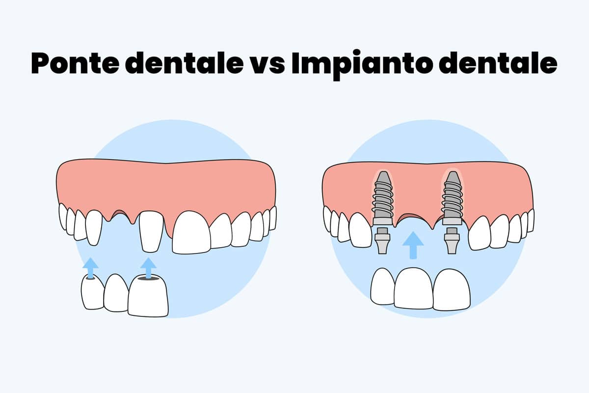 ponte dentale vs impianto dentale