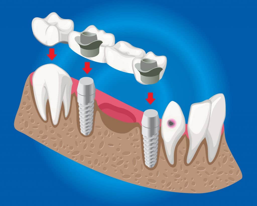 Protesi fissa senza impianto dentale