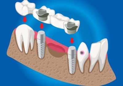 Protesi fissa senza impianto dentale