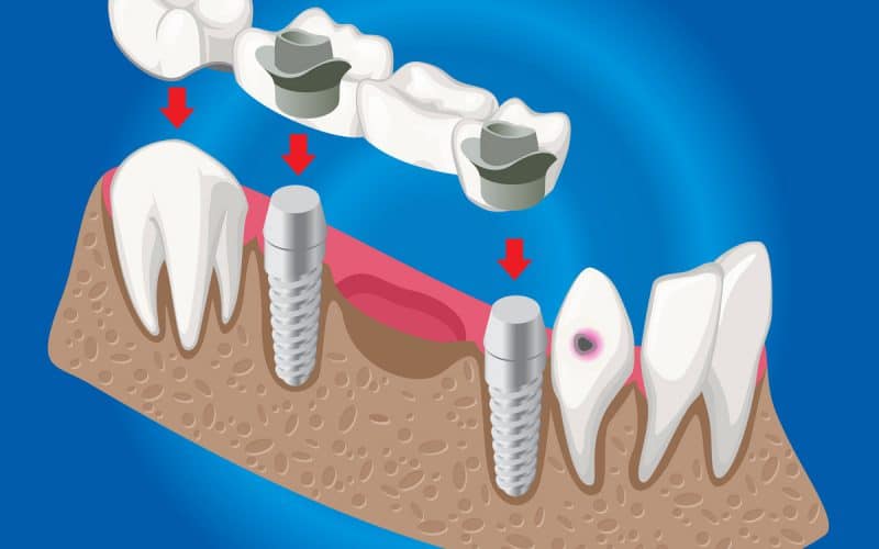 Denti fissi senza impianto