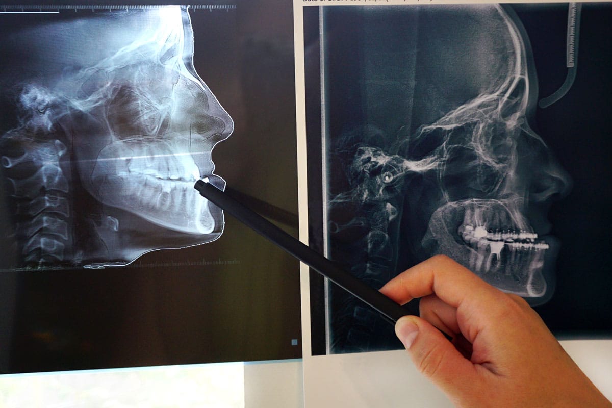 Infezione all’impianto dentale (Perimplantite): Guida Completa