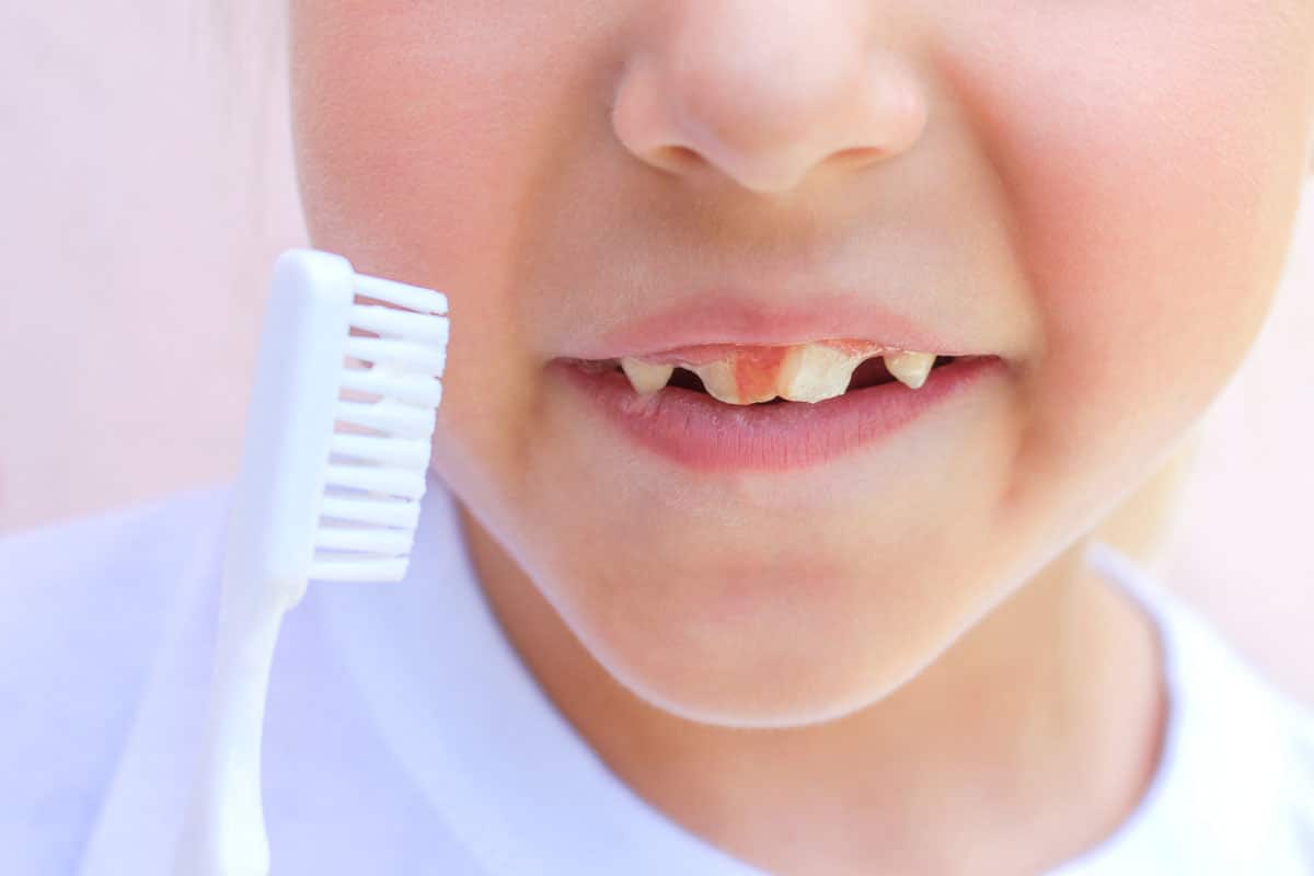 Gengivite nei bambini: cause, sintomi e rimedi