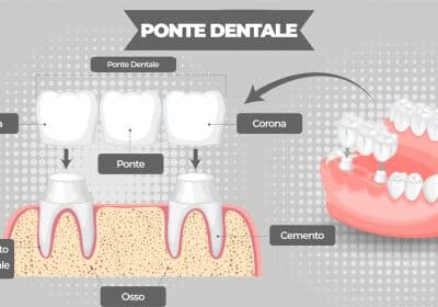 ponte dentale