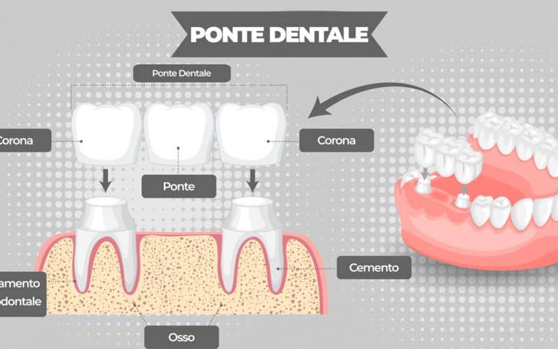 Ponte dentale