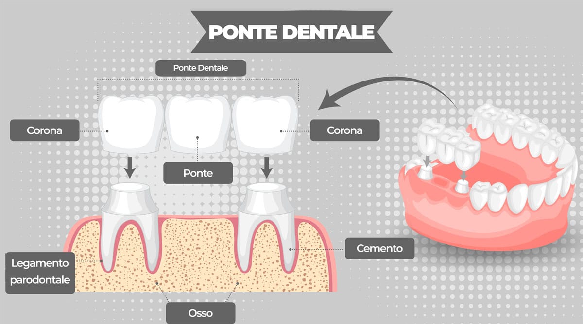 Ponte dentale: tutto quello che c'è da sapere - Dental Factor