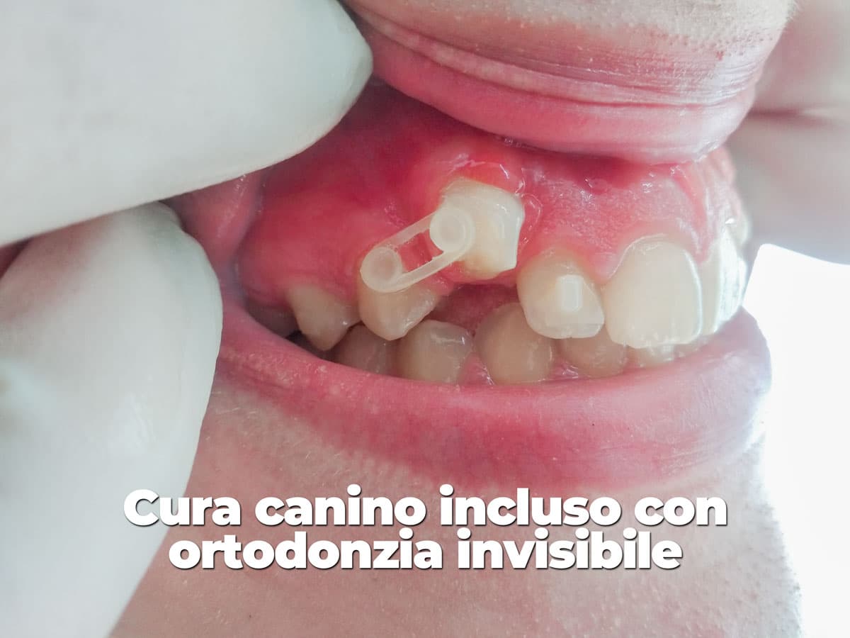 trattamento di cura per un dente canino incluso tramite l'apparecchio invisibile