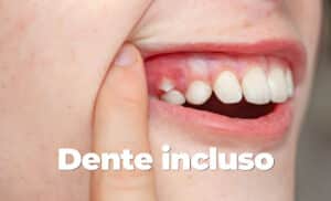 dente incluso