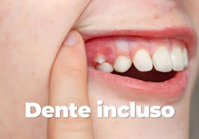 dente incluso