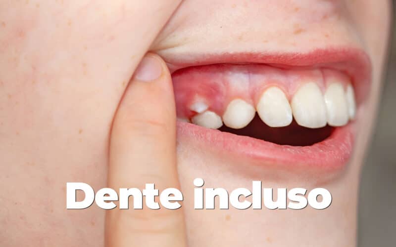 Dente incluso: cos’è e come risolvere il problema