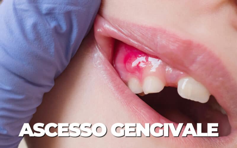 Ascesso gengivale: cos’è, prevenzione e cura