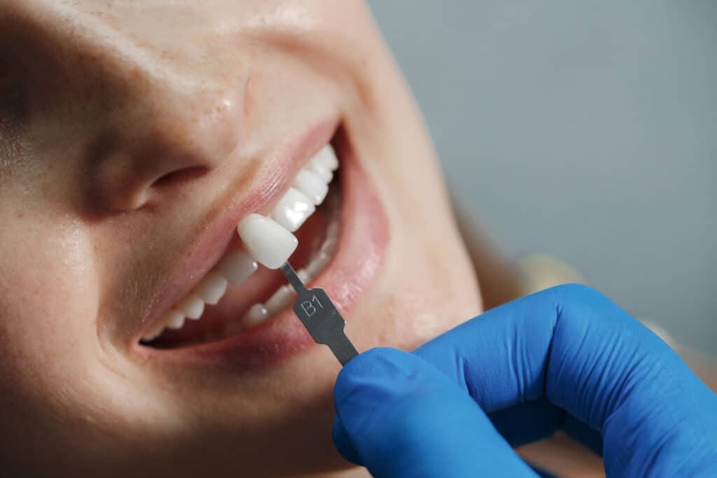 Faccette dentali prep e no prep