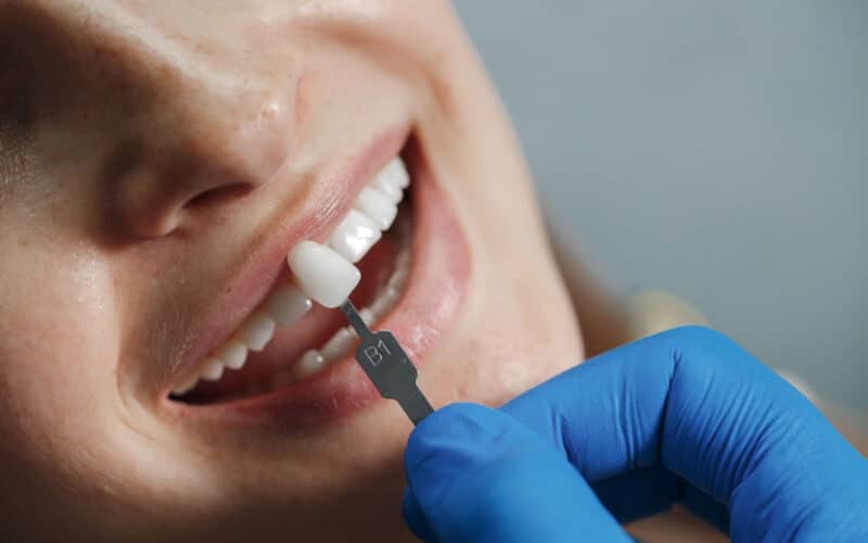 Faccette dentali prep vs no prep: tutto quello che devi sapere