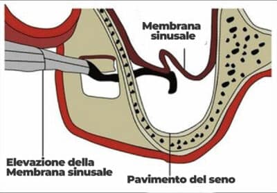 Perforazione membrana sinusale