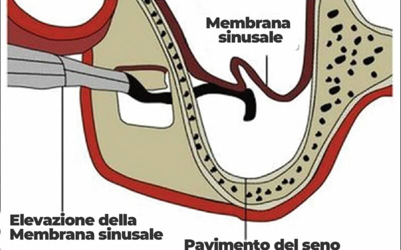 Perforazione di membrana durante rialzo di seno mascellare