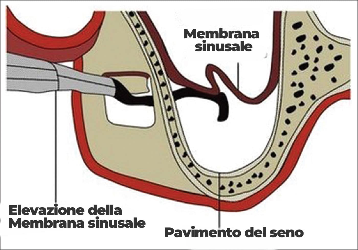 Perforazione di membrana durante rialzo di seno mascellare