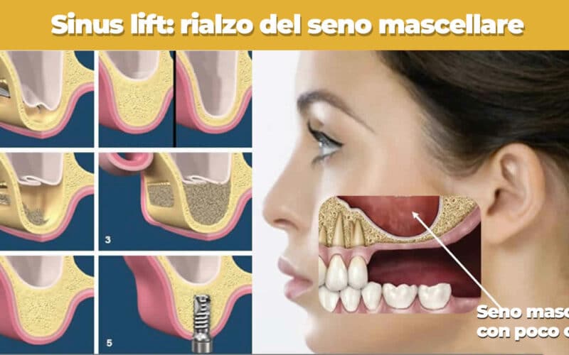 Sinus Lift: Rialzo del seno mascellare