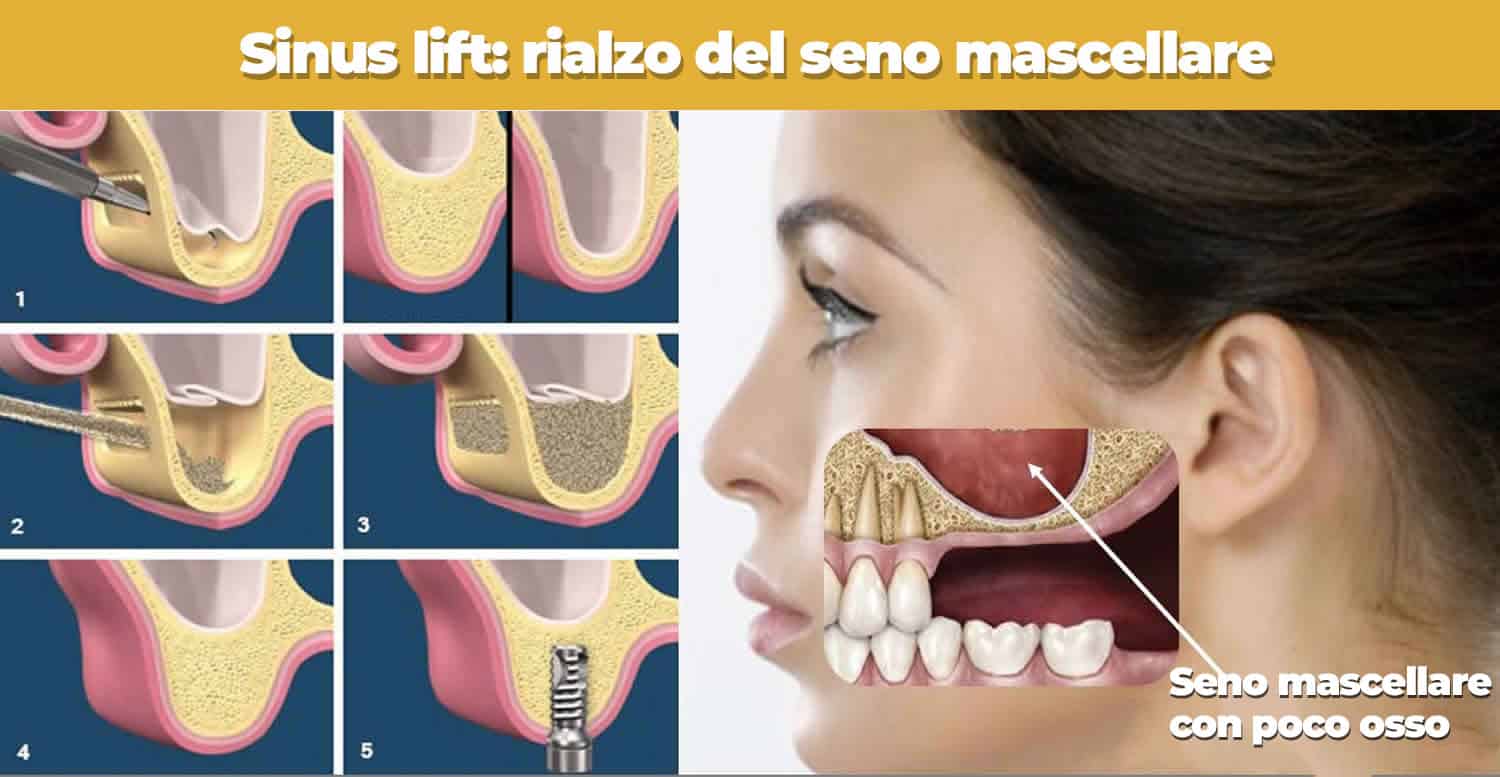 Sinus Lift: Rialzo del seno mascellare