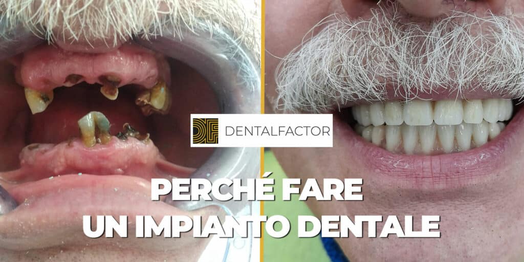 perché fare un impianto dentale