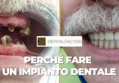 perché fare un impianto dentale