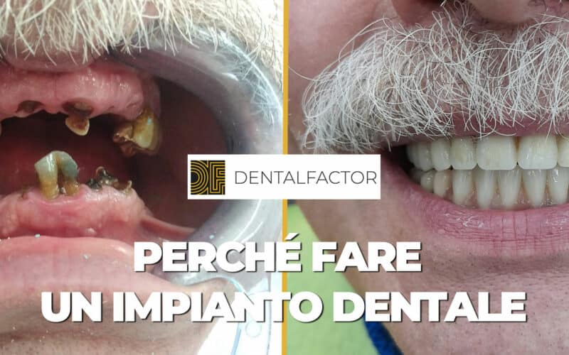 Perché fare un impianto dentale?