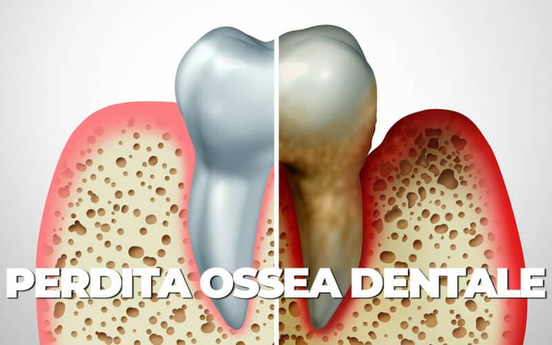 Perdita ossea dentale: Perché si ritira l’osso dei denti?