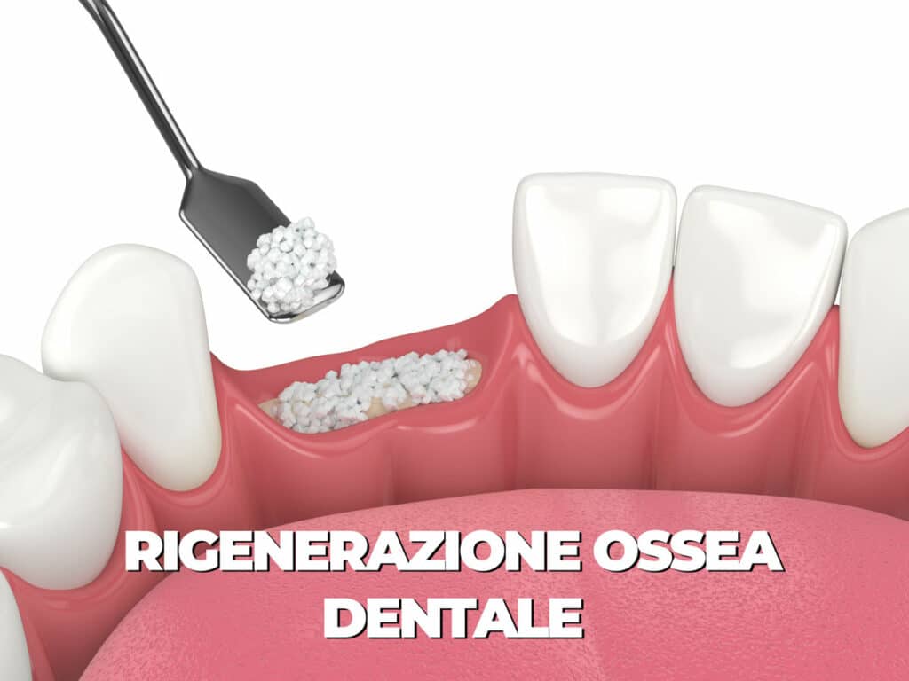 rigenerazione ossea dentale