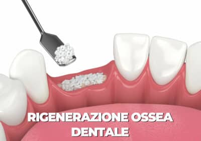 rigenerazione ossea dentale