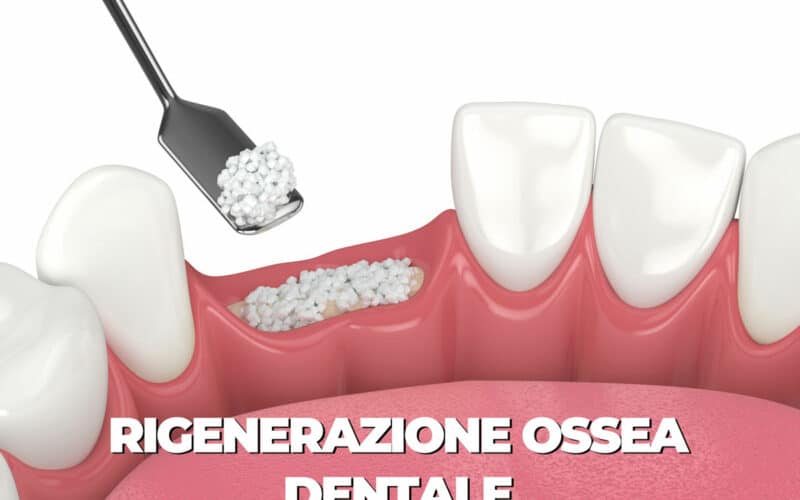 Rigenerazione ossea dentale: ricostruire l’osso per mettere gli impianti