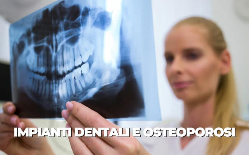 Impianti dentali e osteoporosi: mettere gli impianti con ossa fragili
