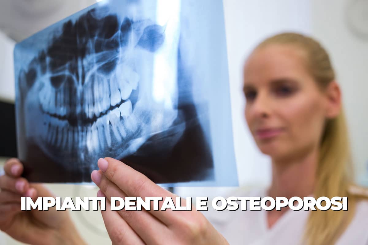 Impianti dentali e osteoporosi: mettere gli impianti con ossa fragili