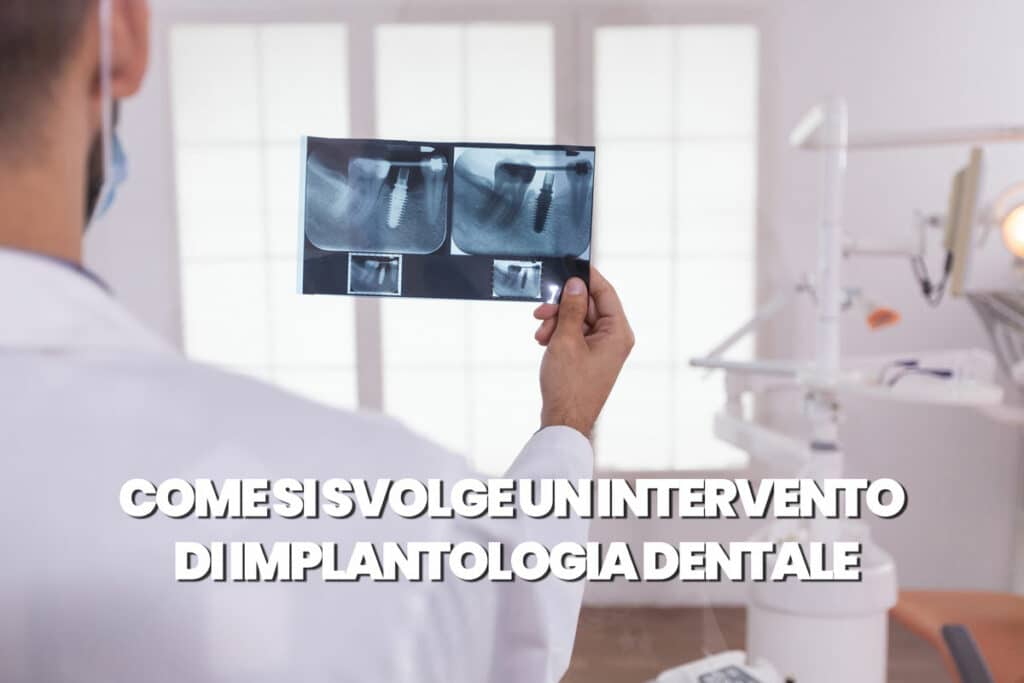 Come si svolge un intervento di implantologia dentale