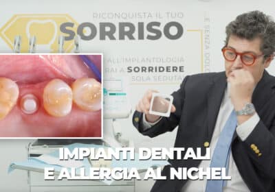 impianti dentali e allergia al nichel