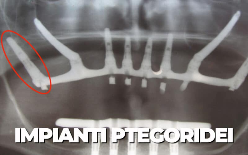 Impianti Pterigoidei: Cosa sono e quando utilizzarli