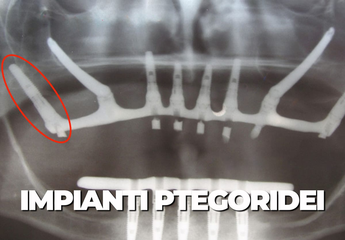 Impianti Pterigoidei: Cosa sono e quando utilizzarli