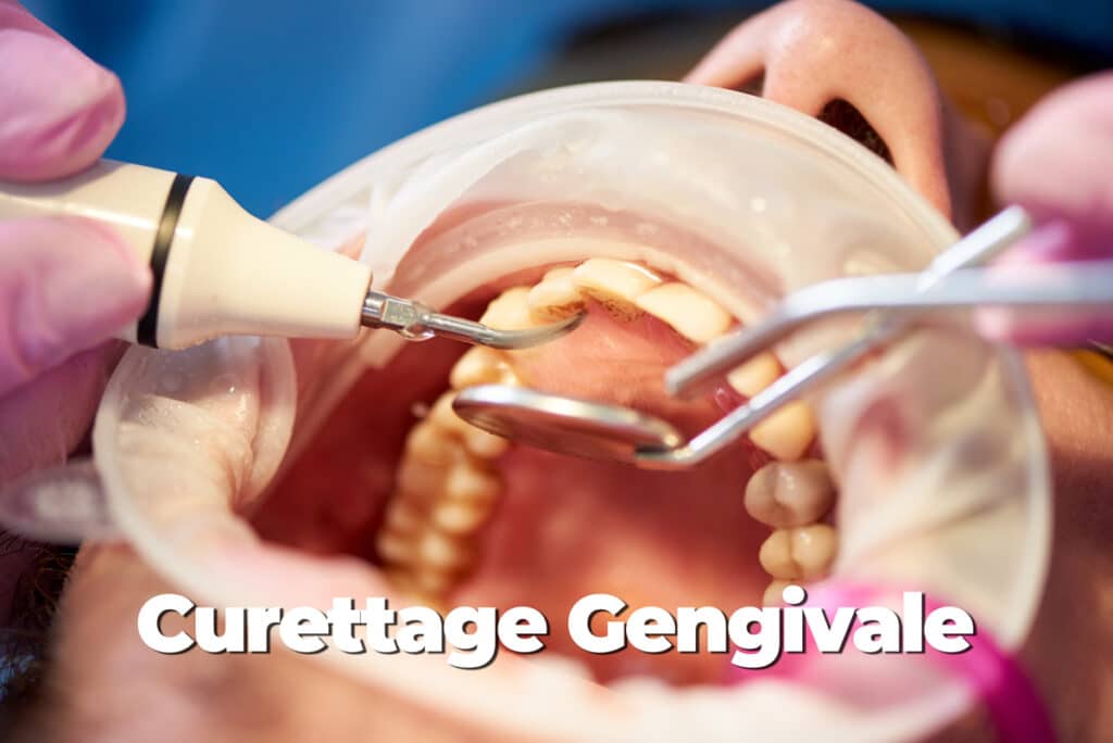Curettage Gengivale
