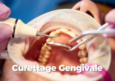 Curettage Gengivale